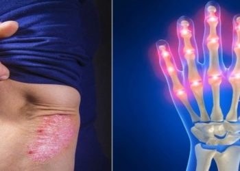 Τα 6 καλύτερα φρούτα για την ψωριασική αρθρίτιδα