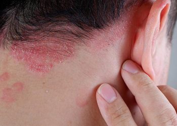 Γιατί η ψωρίαση είναι ήπια σε κάποιους και βαρύτερης μορφής σε άλλους
