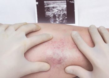 Τι μπορεί να κρύβουν οι κιρσοί στα πόδια και γιατί είναι σοβαρή πάθηση
