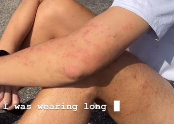 Γερμανία: Εφιάλτης για ζευγάρι τουριστών από την Αυστραλία – Τους δάγκωσαν κοριοί μέσα σε τρένο