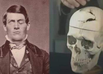 Του καρφώθηκε σιδερένια ράβδος στο κρανίο και επιβίωσε: Η ιστορία του ανθρώπου που έγραψε ιστορία