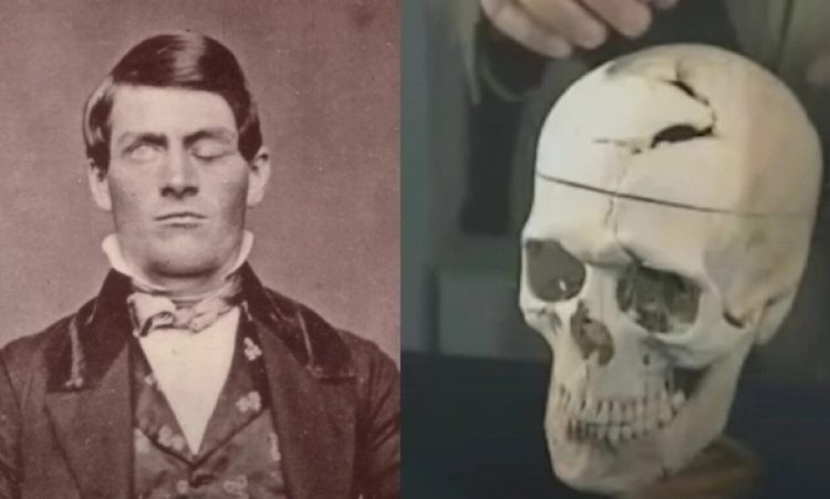 Του καρφώθηκε σιδερένια ράβδος στο κρανίο και επιβίωσε: Η ιστορία του ανθρώπου που έγραψε ιστορία