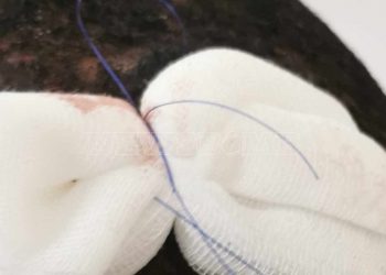 Κυψέλη: Με ράμματα στο κεφάλι ο μαθητής που ξυλοκοπήθηκε από 19χρονο
