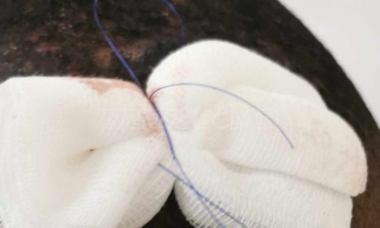 Κυψέλη: Με ράμματα στο κεφάλι ο μαθητής που ξυλοκοπήθηκε από 19χρονο