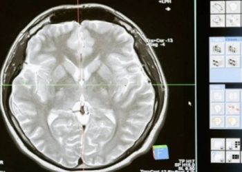 O ανθρώπινος εγκέφαλος έχει μεγαλώσει κατά 7%από το 1930 – Ο δείκτης νοημοσύνης έχει υποχωρήσει