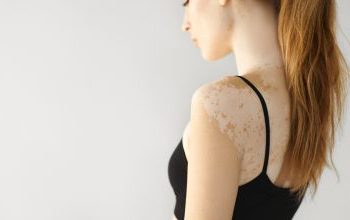 Λεύκη: 9 μύθοι που δεν πρέπει να πιστεύουμε και τι ισχύει στ’ αλήθεια