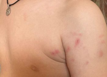 Αιτωλικό: Αδέσποτος σκύλος επιτέθηκε σε ανήλικο – Με σοβαρά τραύματα στο νοσοκομείο