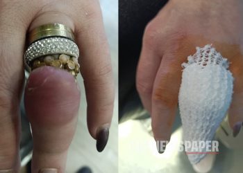 «Σφήνωσαν» στο δάχτυλό της 4 δαχτυλίδια – Γλίτωσε τα χειρότερα χάρη στην έγκαιρη αφαίρεσή τους (ΕΙΚΟΝΕΣ – ΒΙΝΤΕΟ)