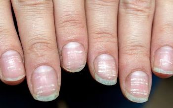 4 λόγοι που έχετε λευκά σημάδια στα νύχια