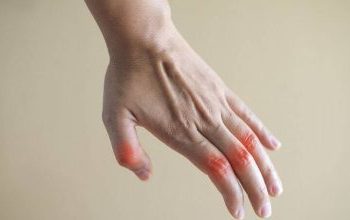 Ρευματοειδής αρθρίτιδα: Το μπαχαρικό που προκαλεί υποχώρηση των συμπτωμάτων