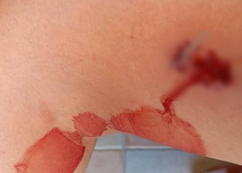 Άγρια επίθεση από αδέσποτα σκυλιά σε 45χρονη: Στο Νοσοκομείο με σοβαρά τραύματα (ΕΙΚΟΝΕΣ)