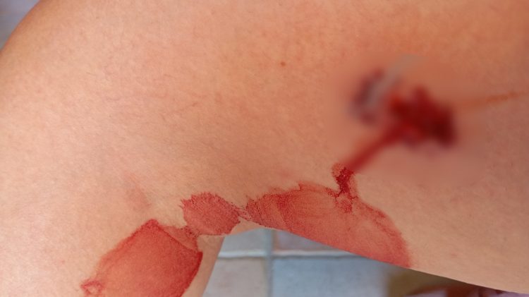 Άγρια επίθεση από αδέσποτα σκυλιά σε 45χρονη: Στο Νοσοκομείο με σοβαρά τραύματα (ΕΙΚΟΝΕΣ)