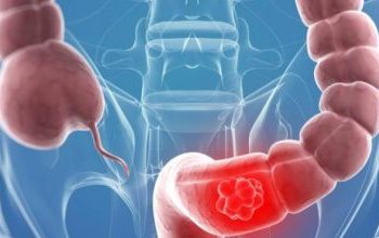 Καρκίνος του παχέος εντέρου: Τα πρώιμα συμπτώματα που δεν πρέπει να αγνοήσετε – Πότε να δείτε άμεσα γιατρό