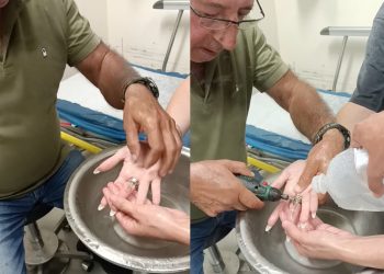 Επιχείρηση αφαίρεσης ατσάλινων δακτυλιδιών στο Νοσοκομείο – Καθοριστική η συμβολή εθελοντή διασώστη