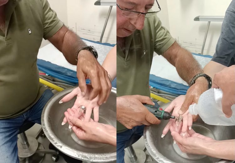 Επιχείρηση αφαίρεσης ατσάλινων δακτυλιδιών στο Νοσοκομείο – Καθοριστική η συμβολή εθελοντή διασώστη