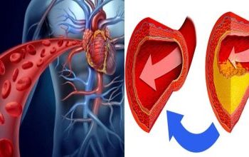 Φραγμένες αρτηρίες: 4 επικίνδυνα σημάδια που δεν πρέπει να αγνοήσετε