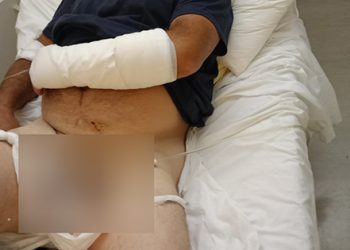 Εζησε τον απόλυτο εφιάλτη στα σαγόνια σκύλων – Tον δάγκωσαν σε χέρι και γεννητικά όργανα!!