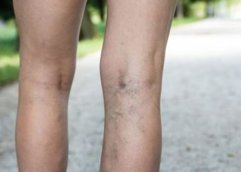 Χαρτογράφηση ευρυαγγειών: Η σύγχρονη αντίληψη στη θεραπευτική τους