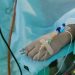 Αποσωληνώθηκε ο 19χρονος Τρικαλινός φοιτητής που προσβλήθηκε από μηνιγγίτιδα