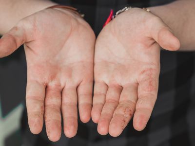 Δυσιδρωτικό έκζεμα: Τα σημάδια σε χέρια και πόδια – Τι να κάνετε