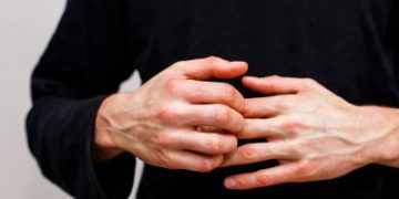 Εξάνθημα Χασιμότο: Πώς μοιάζει το σημάδι θυρεοειδίτιδας στο δέρμα